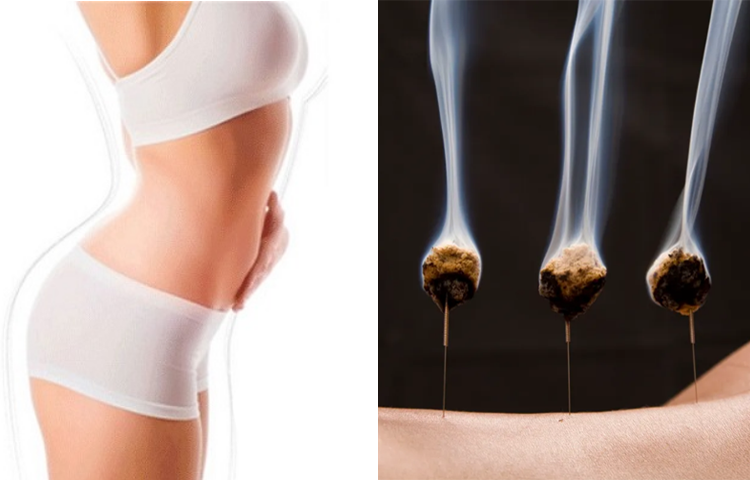 Cứu điều trị kinh nguyệt không đều (Kinh trước kỳ; Kinh sau kỳ; Kinh không định kỳ)